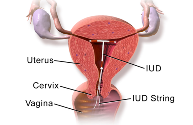 Intrauterine device (IUD) for birth control – Diagram showing an IUD inside uterus